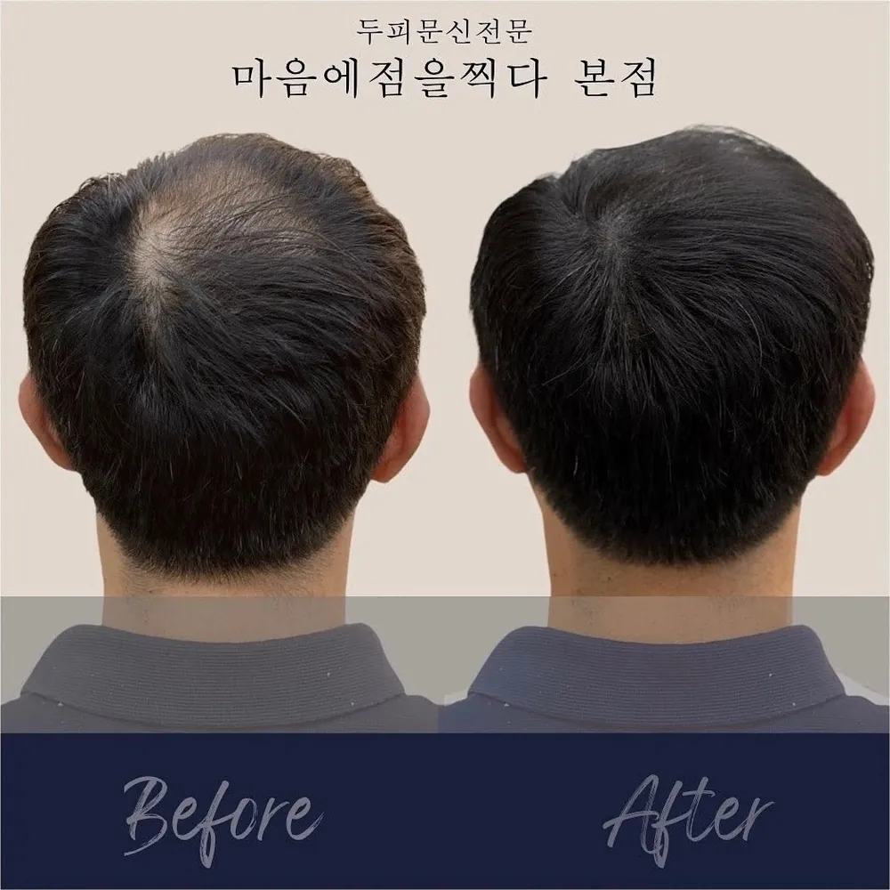 전남 정수리 두피문신 사례