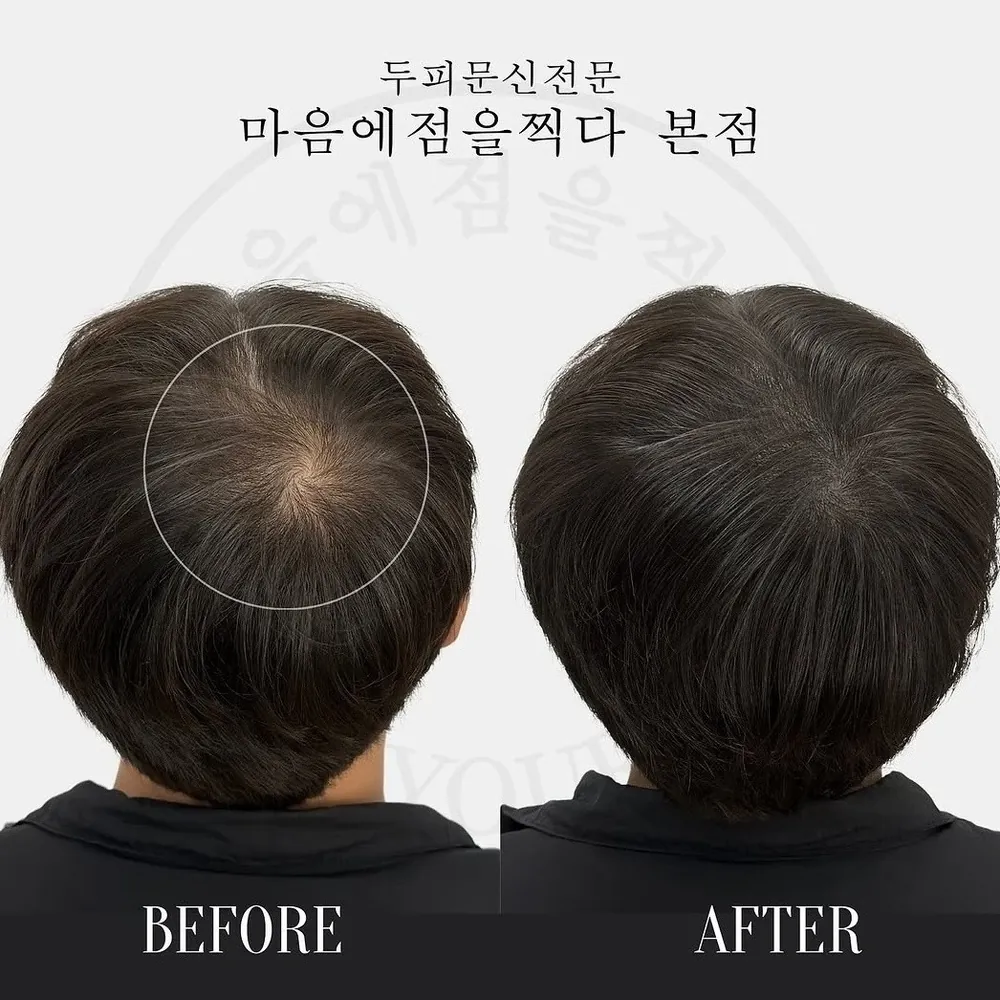 정수리 두피문신 전후 사례