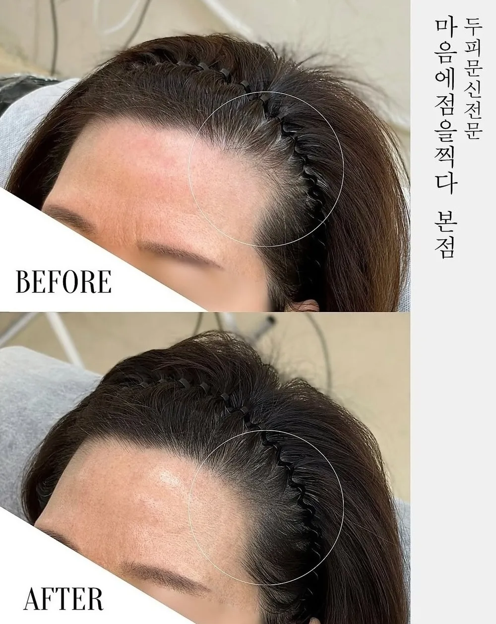 헤어라인 두피문신 전후 사례