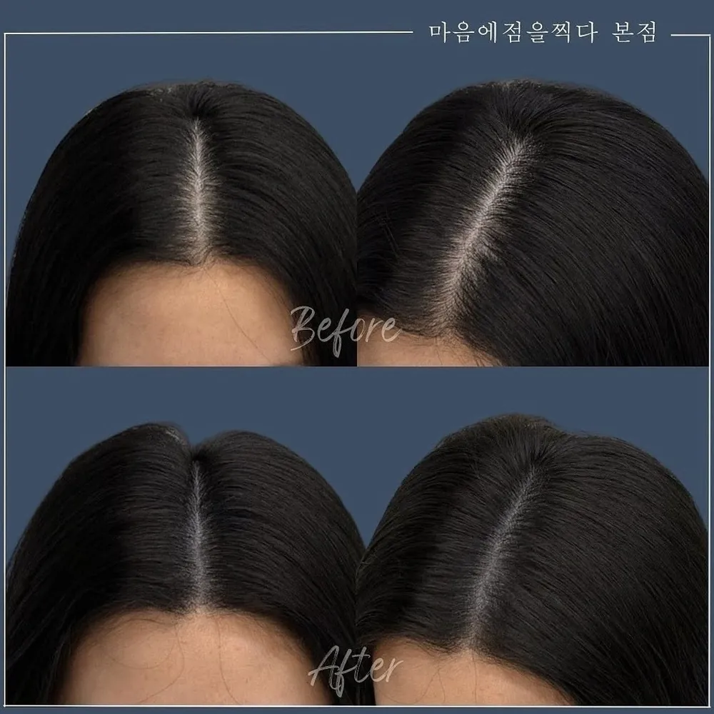 여성 가르마 두피문신 전후 사례