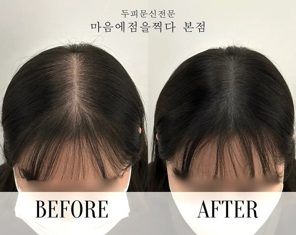 가르마 두피문신 전후 사례