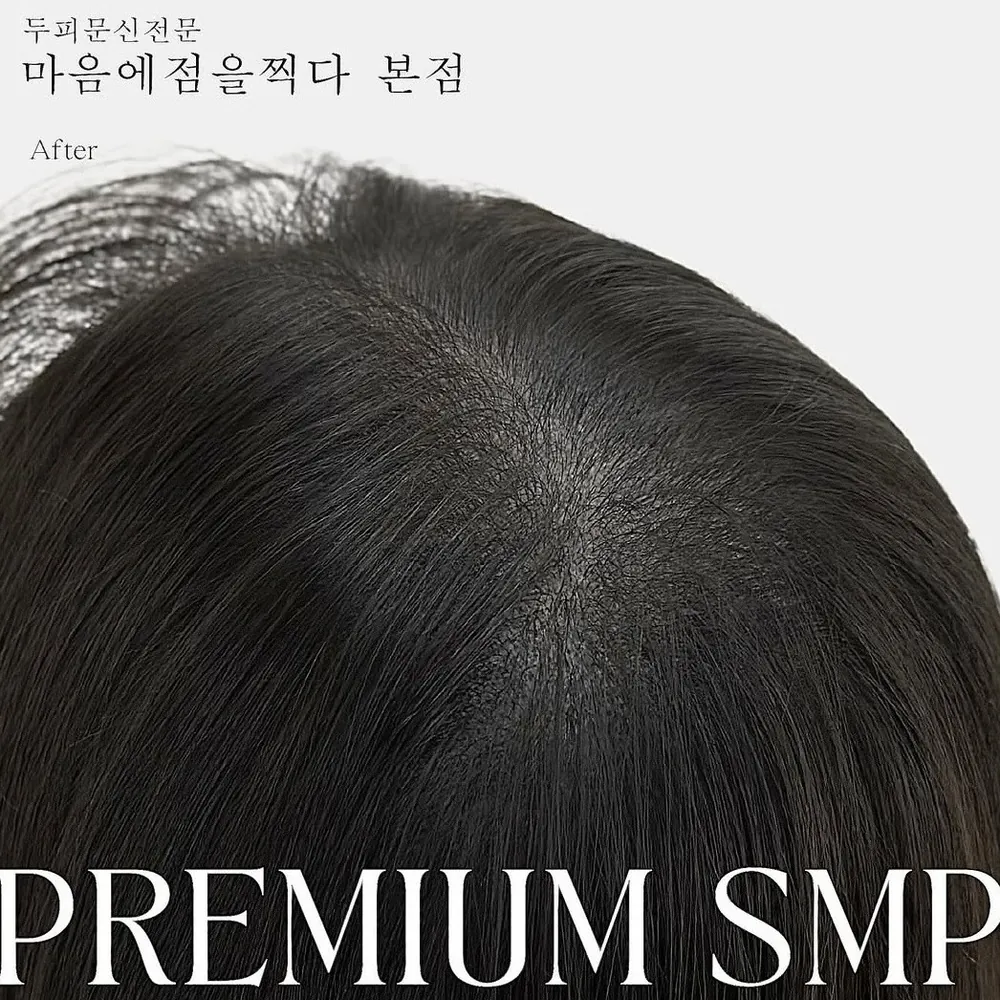 프리미엄 SMP 정수리 시술 결과