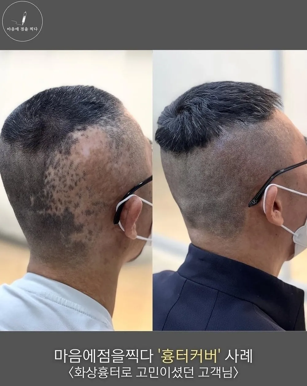 화상 흉터 커버 두피문신 전후 사례
