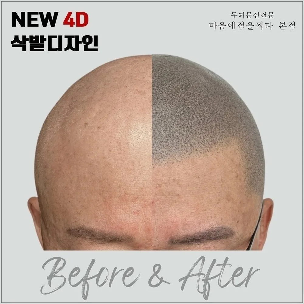삭발 디자인 두피문신 전후 사례