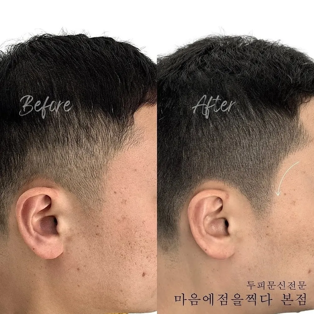 구레나룻 두피문신 전후 사례