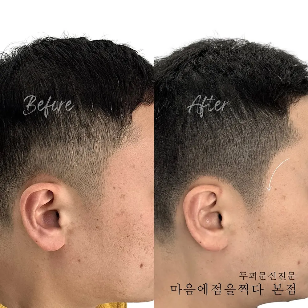 광주 구레나룻 두피문신 사례