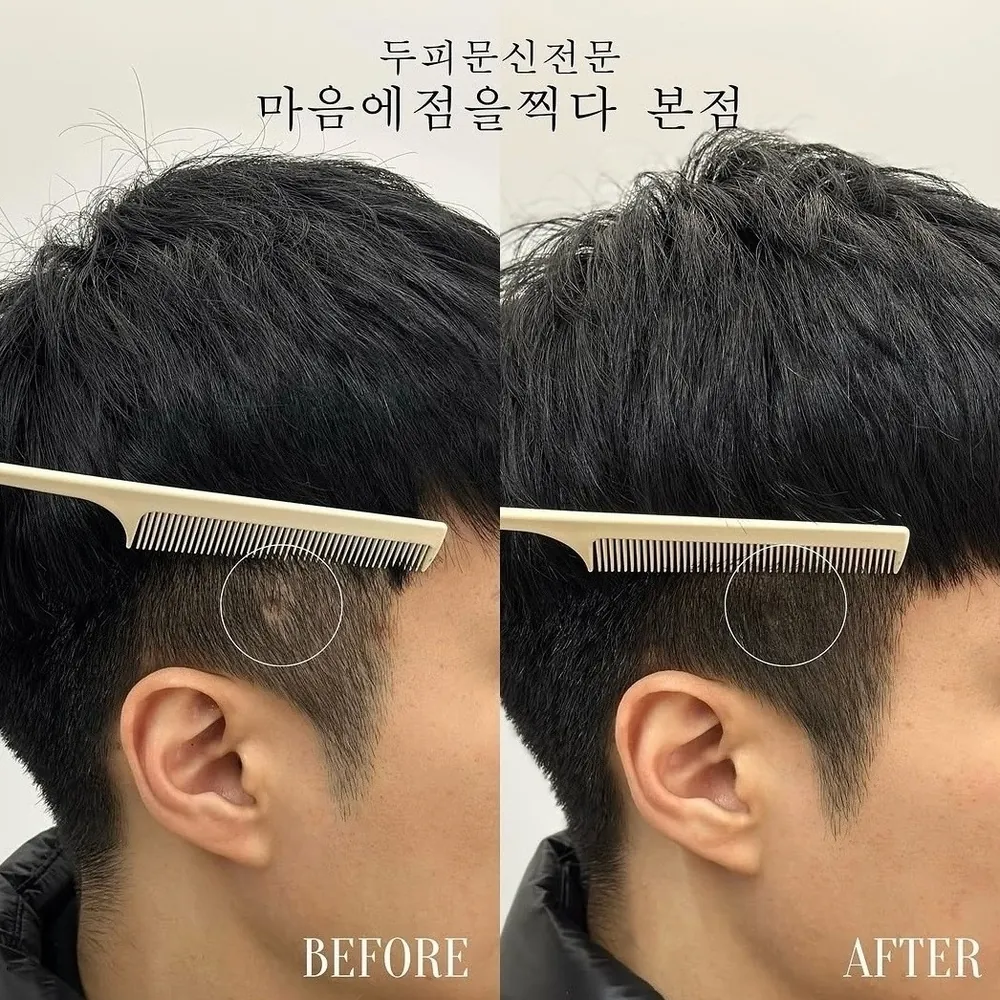 구레나룻 두피문신 전후 사례